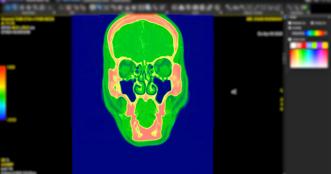 High-resolution Computed Tomography Angiography (CTA) scan showcasing the human brain and carotid arteries in the neck. Essential for diagnosing stroke, stenosis, and vascular health