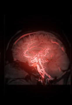 High-tech glowing red Magnetic Resonance Angiography (MRA) of human brain blood vessels on a dark background. Ideal for stroke, neurology, and medical research concepts.