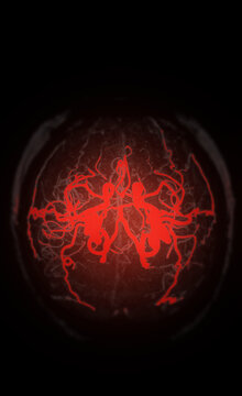 High-tech glowing red Magnetic Resonance Angiography (MRA) of human brain blood vessels on a dark background. Ideal for stroke, neurology, and medical research concepts.
