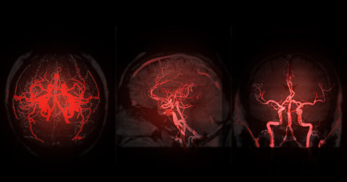 Collage of three glowing red MRI MRA brain scans showing axial, sagittal, and coronal views. Perfect for comprehensive neurology, brain tumor diagnosis, and medical presentations.