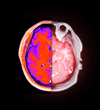 Authentic axial MRI brain scan showing a split-screen comparison. The left side displays thermal color mapping, while the right shows a standard view. Great for medical analysis concepts.