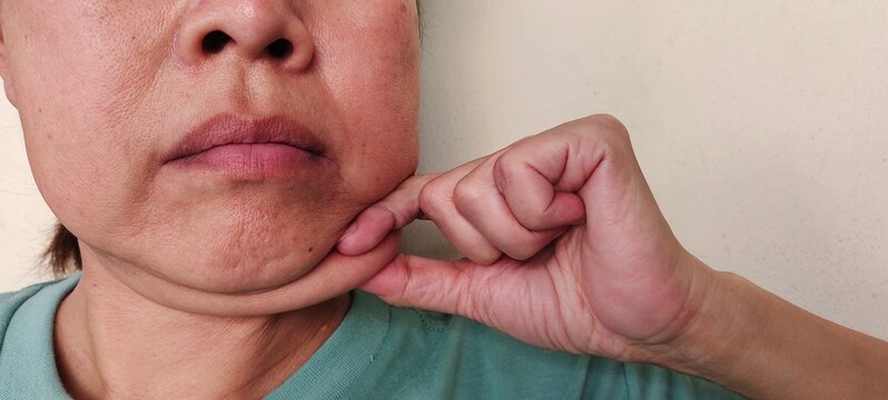 portrait the fingers holding the flabbiness adipose sagging skin under the chin, neck wattle and cellulite, large and layer skin of the woman, health care and beauty concept.