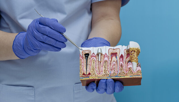 Dentist pointing at tooth root canal infection and pulpitis on anatomical jaw cross-section model.