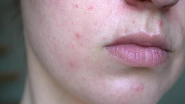 Close up of young woman with acne, visible pores and redness. Real skin texture. Skincare, dermatology and cosmetic treatment concept for beauty industry.
