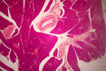 Microscopic stained section of tissue showing dense areas of magenta cells, light branching areas,...