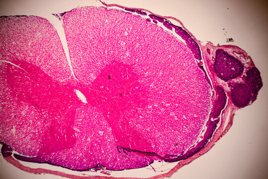 Microscopic stained section of tissue showing dense pink layered structures, pale cavities, and cellular textures.