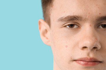 Fototapeta premium Teenage boy with acne on blue background, closeup
