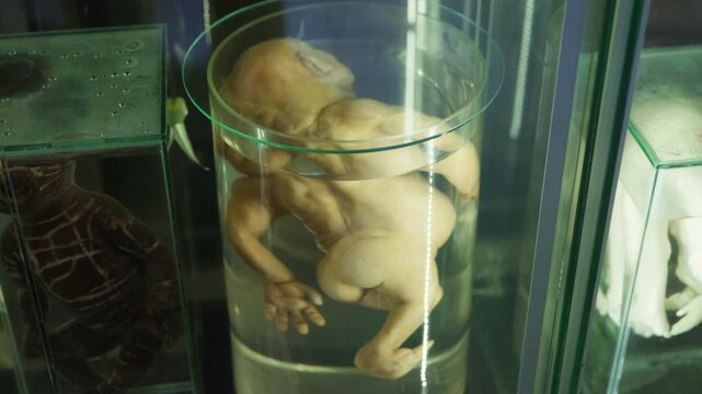 Exhibition of anatomical exhibits. A human infant with the pathological development of anencephaly