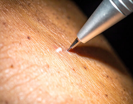 Clinical penlight illuminating the edge of a wound on dark skin to reveal textural changes in dermis.