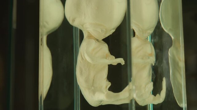 Exhibition of anatomical exhibits. A human infant with the pathological development of anencephaly