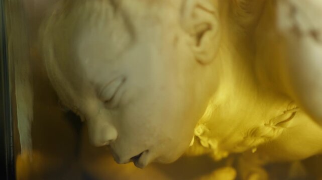 Exhibition of anatomical exhibits. A human infant with the pathological development of anencephaly