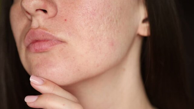 Young woman with acne-prone skin and post-acne hyperpigmentation touching her face, emotional skincare and self-esteem concept