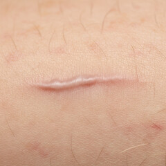 Fototapeta premium Detailed view of a mature surgical scar on human skin featuring realistic textures and pale tissue against a sterile white background medical healing concept