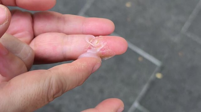 The process of healing thickened skin on the fingers by applying a skin ointment. This will encourage the body's regeneration process and the renewal of the skin's protective layer. Medical education.