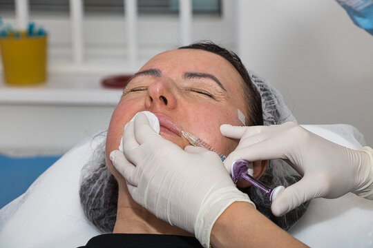 A cosmetologist performs lip augmentation injections on a middle-aged woman.