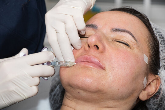A cosmetologist performs lip augmentation injections on a middle-aged woman.