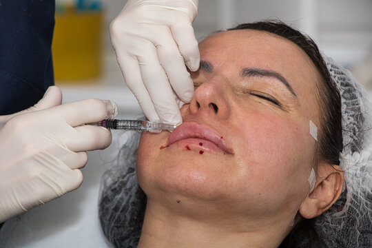 A cosmetologist performs lip augmentation injections on a middle-aged woman.
