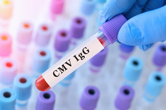 Doctor holding anti HAV IgG blood test tube explaining long term immunity to hepatitis A, past infection or vaccination status assessment in clinical laboratory diagnostics
