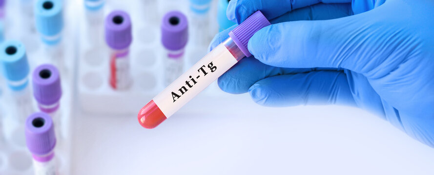 Doctor holding anti thyroglobulin blood test tube explaining detection of autoimmune thyroid antibodies for thyroid disease diagnosis, immune response evaluation and clinical laboratory testing