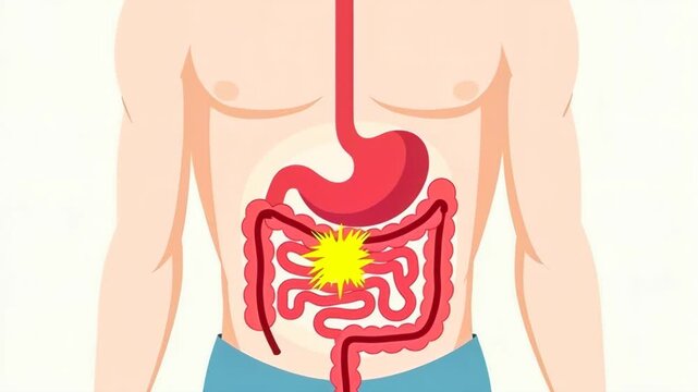 Digestive tract inflammation shown. Intestines with red flare. Gut health issue depicted. Gastroenterology, digestive system function. Concept of nutrition and inflammation.
