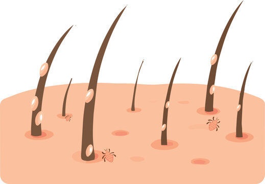illustration of human scalp with head lice and nits attached to hair strands. Suitable for healthcare, hygiene, dermatology, and hair care concepts.