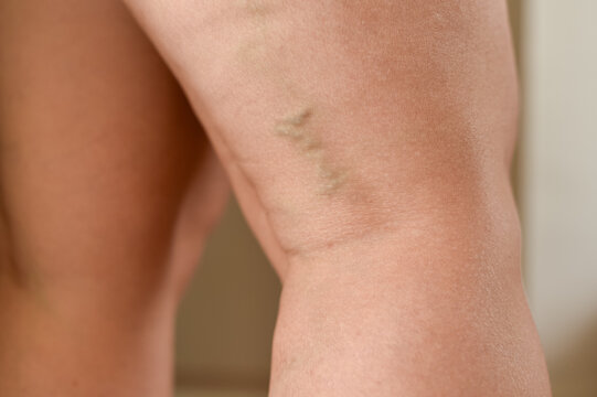 Close-up of a human leg showing visible bulging varicose veins on the thigh and knee area.