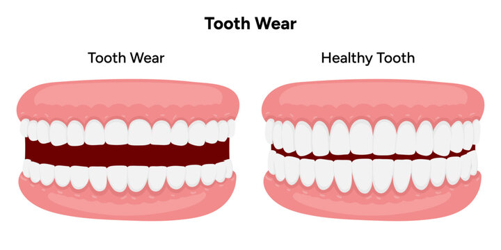 Hand-drawn illustration of tooth wear dental and medical style. Detailed composition gradual enamel loss, flattened tooth surfaces, and structural changes. Educational visual designed