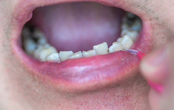 A close up of a person using a interdental brush to clean in between the teeth.