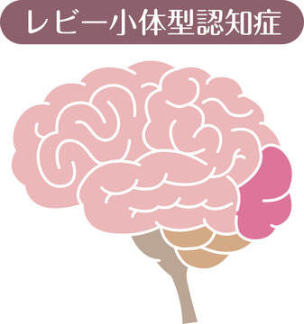 Lewy body dementia brain illustration flat