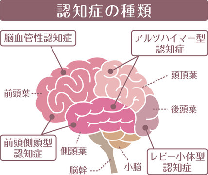 Types of dementia brain illustration flat style