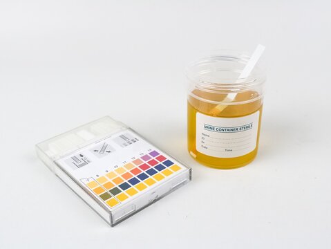 Urine sample in a sterile container, with test strips and a color chart isolated on white background