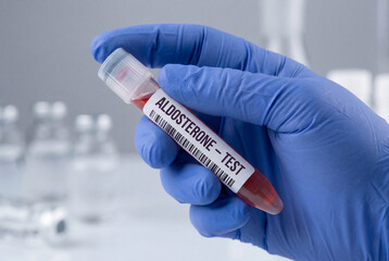 Obraz premium Doctor holds a blood sample tube for an aldosterone hormone test in a medical clinic