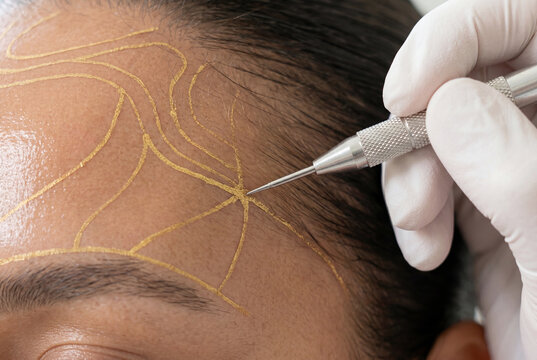 Gloved hand holding cosmetic tool over forehead with gold lines