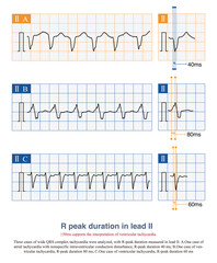 Obraz premium In cases of wide QRS complex tachycardia, a R peak duration of ≥50ms in lead II supports the interpretation of ventricular tachycardia, with a sensitivity of 92.4% and a specificity of 64.7%. 