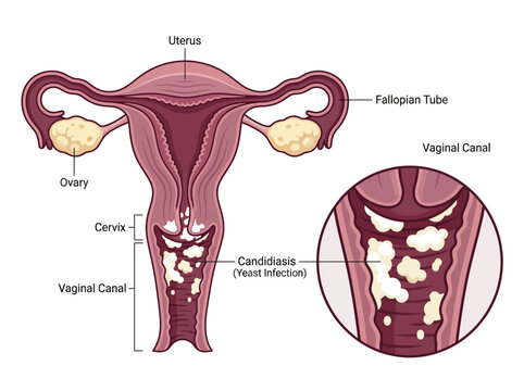 Medical Illustration of Female Reproductive System Showing Candidiasis Yeast Infection in the Vaginal Canal with Anatomical Labels