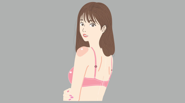 Woman with sunburn on shoulders and back, concept of skin care and sun protection.