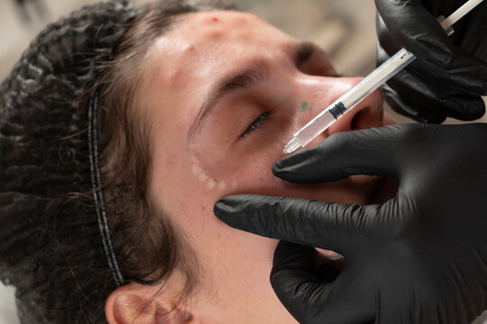 Close up of cosmetologist performing facial cosmetic injection on young woman in beauty clinic. Aesthetic procedure for skin care and wrinkle reduction. Professional cosmetology and skincare concept.