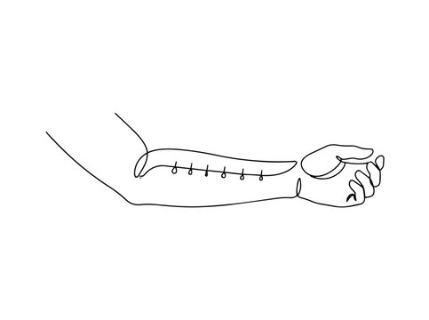 Allergy test on arm. Continuous line art illustration of medical skin testing. Minimalist healthcare vector