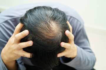 Fototapeta premium Bald head in man, hair loss treatment health problem.