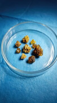 Urinary concretion issue: kidney stone, cause problem, create discomfort, induce pain, mineral form, human ailment, renal disease, medical specimen, collect deposit, body trouble, clinical finding.