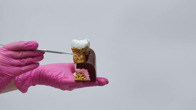 Model of a tooth with periodontitis: a dentist points to tartar and makes a thumbs-down gesture.