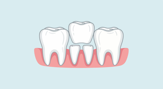 Cartoon depiction of healthy and unhealthy teeth in pink gums