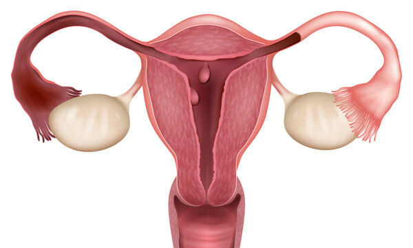 Female Reproductive System Anatomy with Endometrial Polyps Uterus Pathology Diagram Showing Uterine Polyps. Medical Illustration of Human Womb with Endometrium Abnormalities 