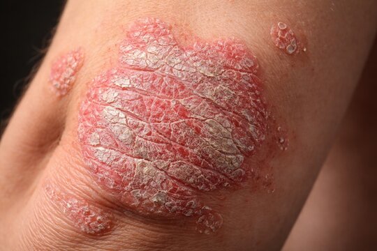 Close up dermatological photography of psoriasis vulgaris for medical education