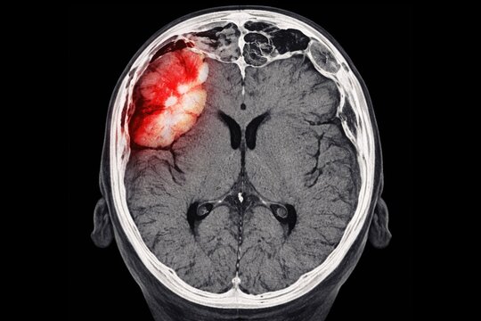 Cranial scan indicates epidural hematoma causing mass effect and multiple sinus fractures