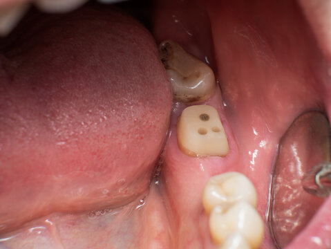 Mandibular second molar, between missing first molar and decayed third molar, rebuilt with posts and composite for prosthetic crown