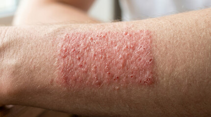 Fototapeta premium Irritated skin from adhesive-ups with red rash on forearm, showcasing reaction to adhesive material. Skin condition features redness and bumps, representing sensitivity and allergic response.