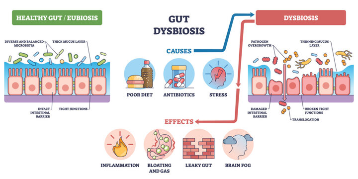 Gut dysbiosis outline shows shift from healthy microbiota to damaged intestinal barrier, highlighting epithelial cells, pathogens, and causes like diet, antibiotics, stress. Outline diagram