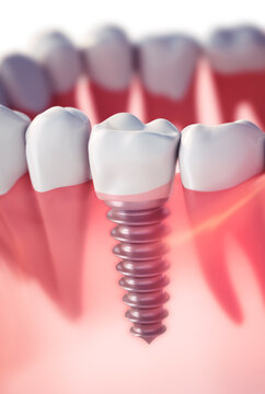 Close-up of a dental implant with crown in the lower jaw against a white background - 3D illustration	
