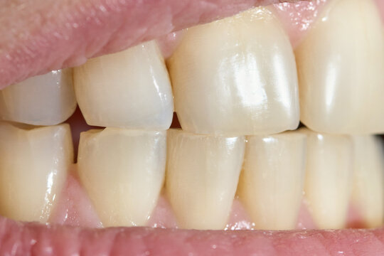 Healthy Looking Human Teeth In Bite Close Up Frontal View Dental Alignment Natural Lighting.